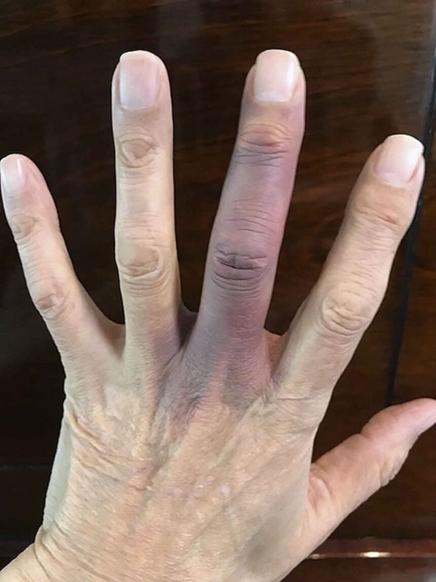 Paroxysmal hand hematoma