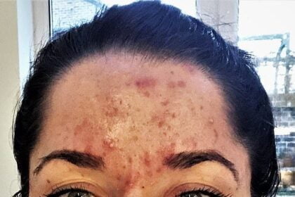 10 Inspiring Images That Prove Acne Is Not Ugly