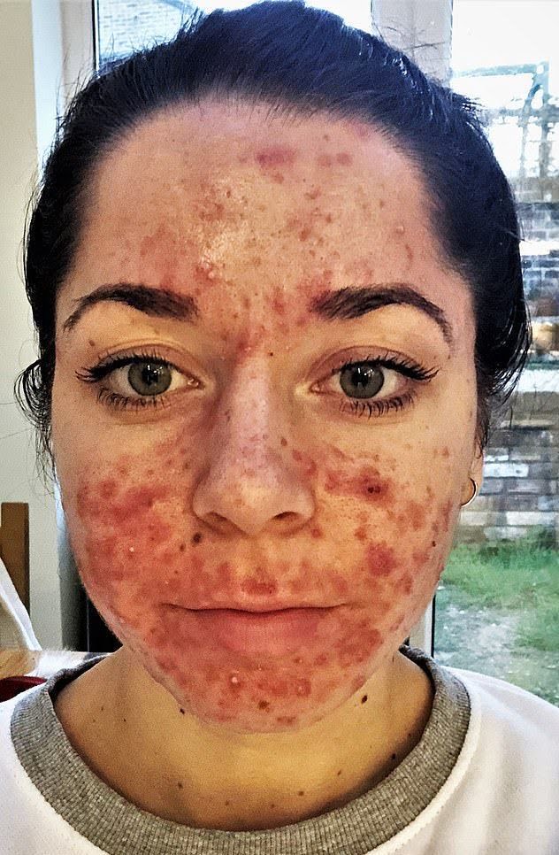 10 Inspiring Images That Prove Acne Is Not Ugly