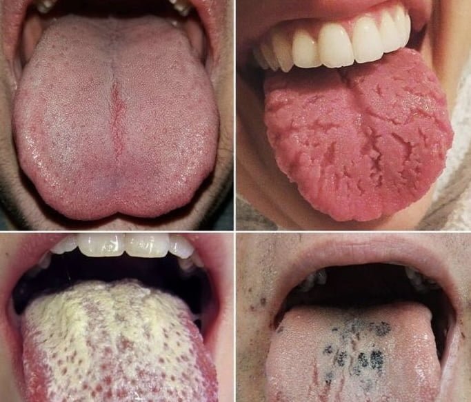 Be Aware Of THIS: These 9 Changes On Your Tongue Reveal Almost All Your Diseases