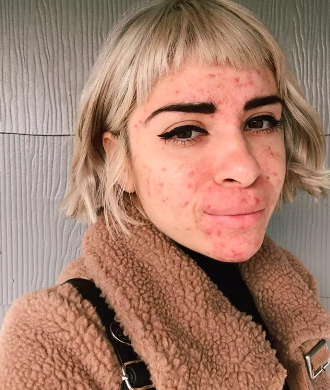 10 Inspiring Images That Prove Acne Is Not Ugly