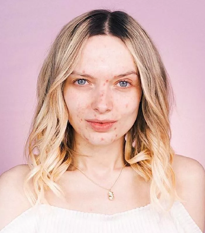 10 Inspiring Images That Prove Acne Is Not Ugly