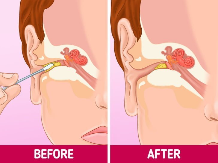 Why You Should Stop Cleaning Your Ears With Cotton Swabs And What to Do Instead