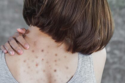 Why Acne Appears on These 8 Body Areas, and What You Should Do