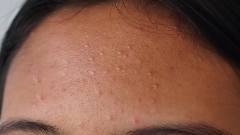 Types of acne: From clogged pores to cysts