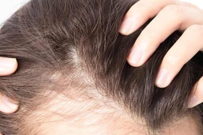 8 Remedies That Can Improve Your Hair Loss Naturally