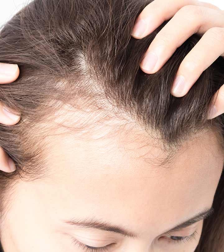 8 Remedies That Can Improve Your Hair Loss Naturally