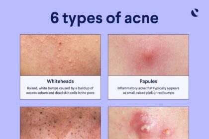 Types of acne: From clogged pores to cysts