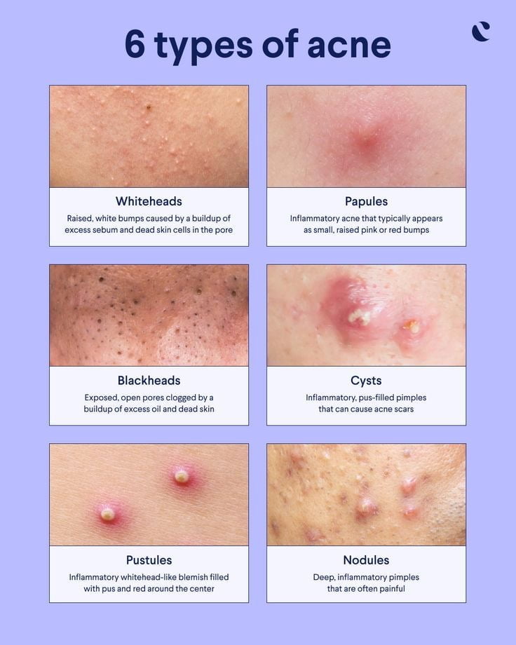 Types of acne: From clogged pores to cysts