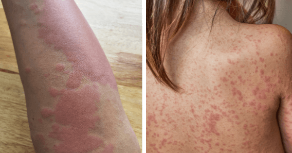 Serious Diseases Diagnosed via Skin Signals