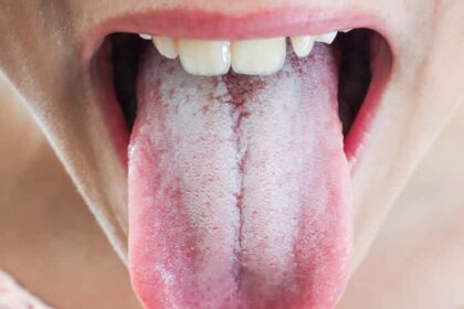 What White Tongue Is, and What to Do About It