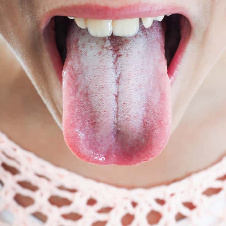 What White Tongue Is, and What to Do About It