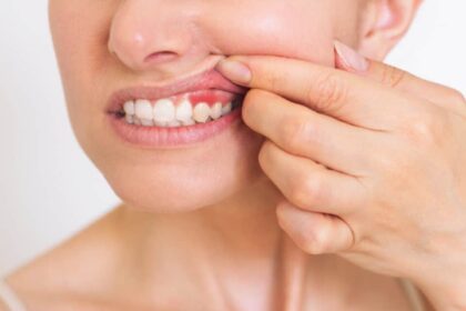 9 Easy Ways to Heal Receding Gums Naturally!