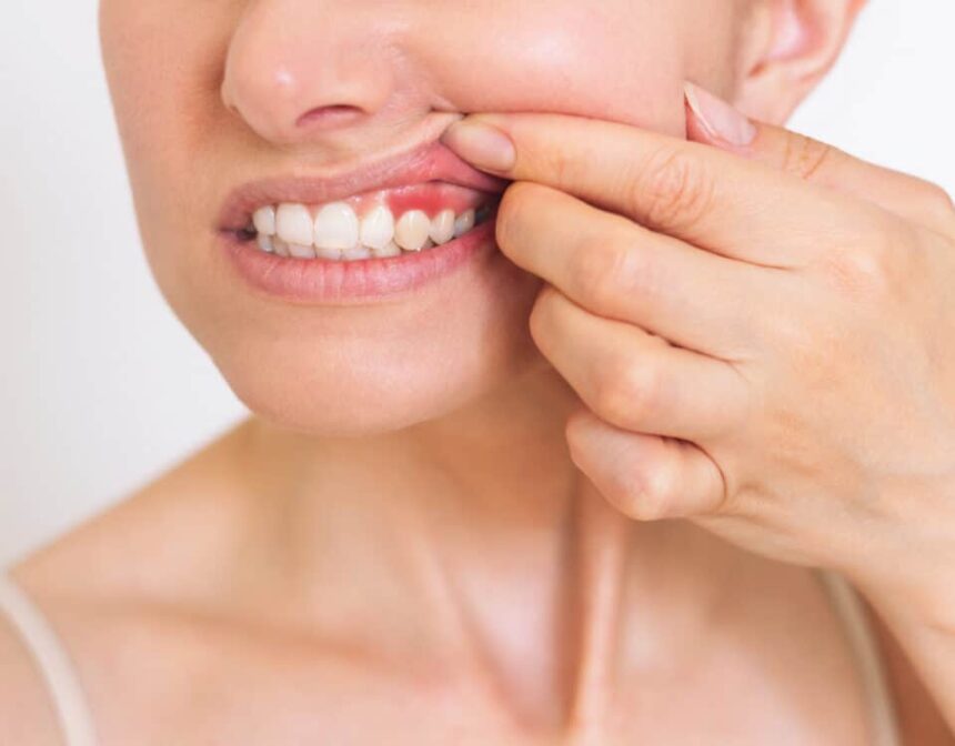 9 Easy Ways to Heal Receding Gums Naturally!