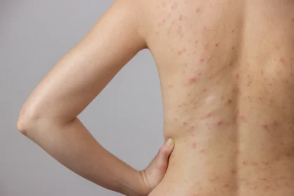 Body Acne: 10 Tips To Get Rid Of Them