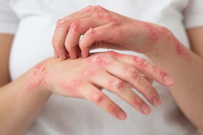 Skin Conditions: Top 10 Most Common