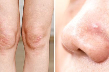 What the Acne on 8 Body Parts Is Trying to Tell You About Your Lifestyle Habits