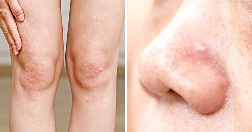 What the Acne on 8 Body Parts Is Trying to Tell You About Your Lifestyle Habits