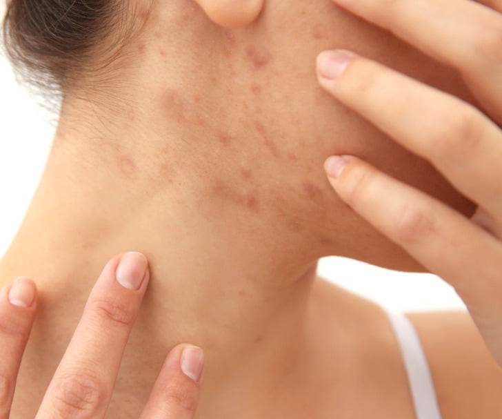 What the Acne on 8 Body Parts Is Trying to Tell You About Your Lifestyle Habits