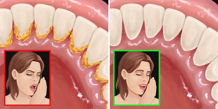 6 Effective Ways To Avoid Bad Breath Even After Sleeping