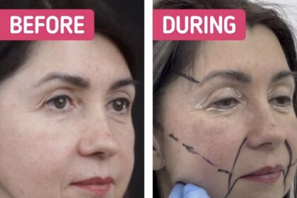 A Woman, 49, Reveals the Dramatic Results of Her Rejuvenation Surgery