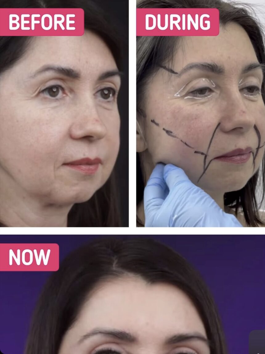 A Woman, 49, Reveals the Dramatic Results of Her Rejuvenation Surgery